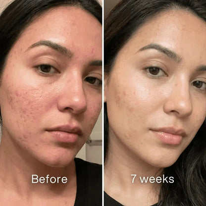Clinical Acne Scar Repair Stick（The second one is 40% off!）
